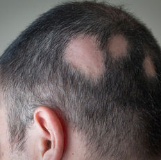 Avaderma Skin & Hair Clinic - Alopecia (Hair Loss)